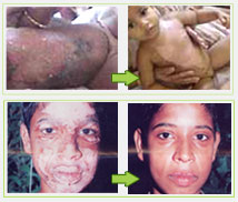 Before & after images of burn cure @ Pathanjali